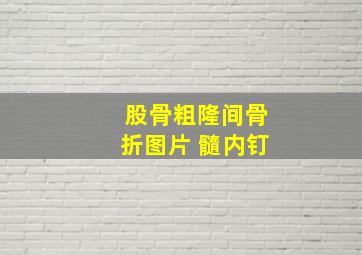 股骨粗隆间骨折图片 髓内钉